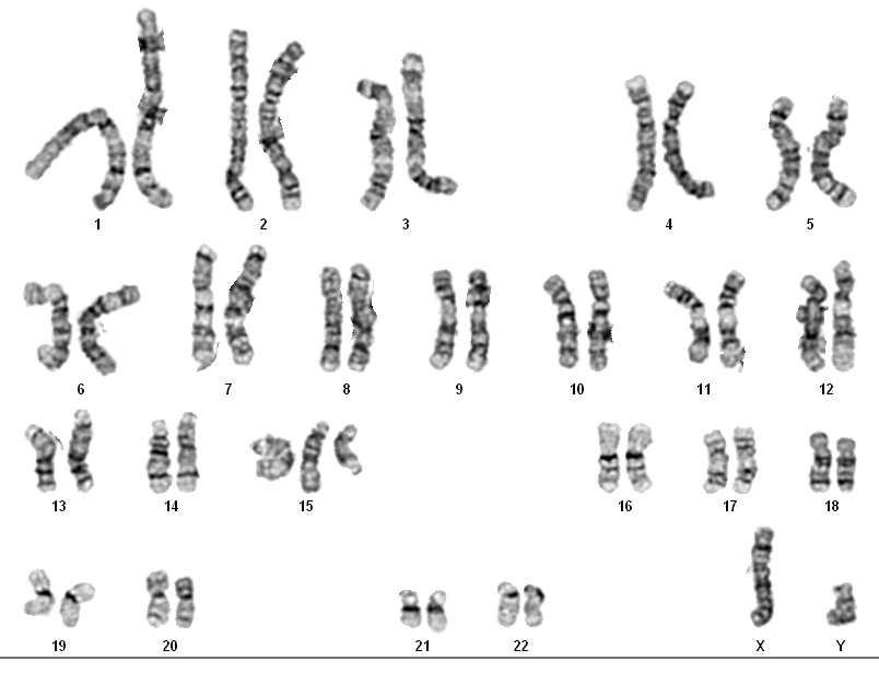 Спаривание хромосом. ATCC CRL-1711 karyotype 2n. Синдром Видемана Беквита кариотип. Хромосома кривая. Лейкоз кариотип.
